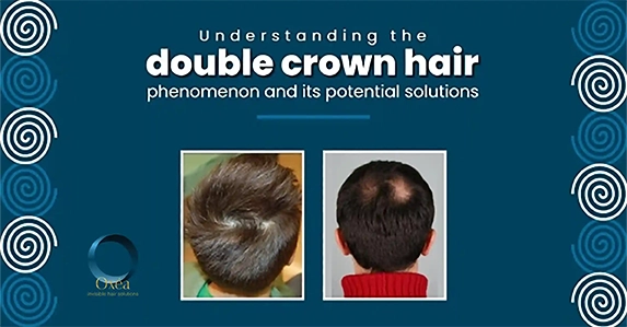 Understanding The Double Crown Hair Its Potential Solutions understanding-the-double-crown-hair-its-potential-solutions
